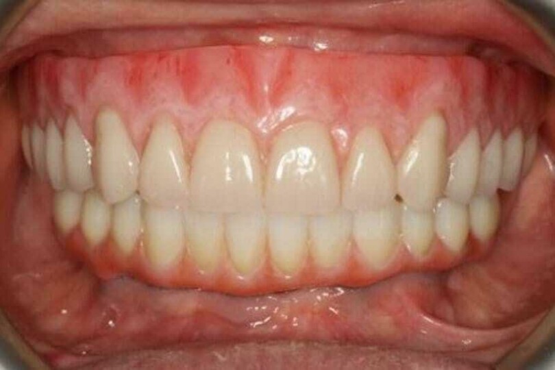 The Complete Implant Removable Prosthesis Course