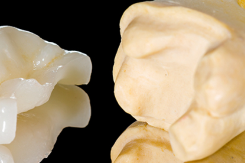 Fundamentals of Ceramic Inlays, Onlays and Overlays