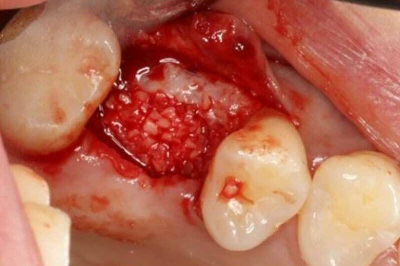 The Total Implant Bone Grafting Course