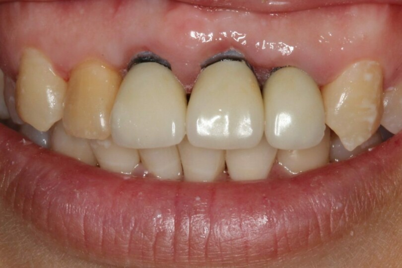 Surgical Management of Periodontitis and Crown Lengthening