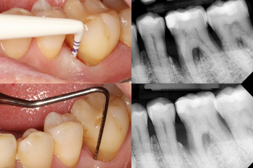 Regenerative Therapies in Periodontics
