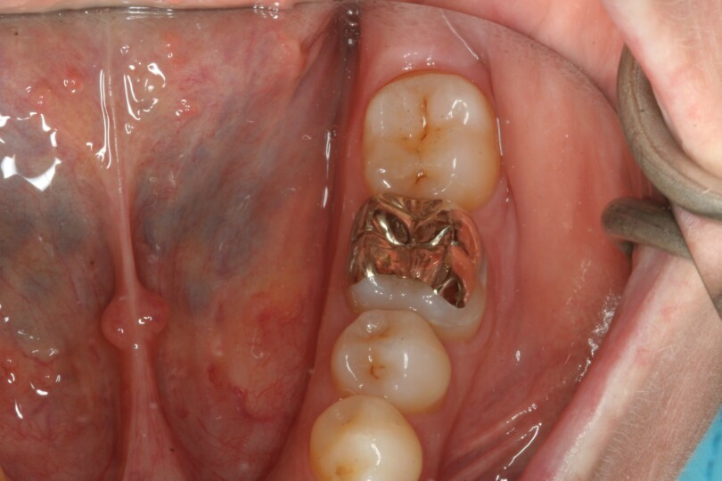 Stabilising remaining/key teeth