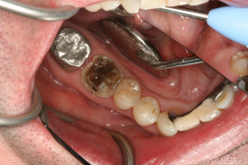 Material indications and approaches for restoration of teeth