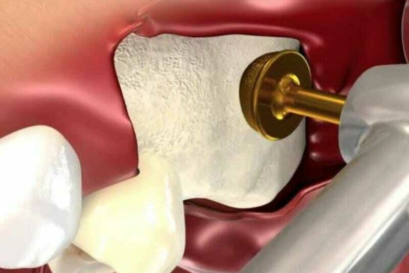 The Complete Maxillary Sinus Lift Course