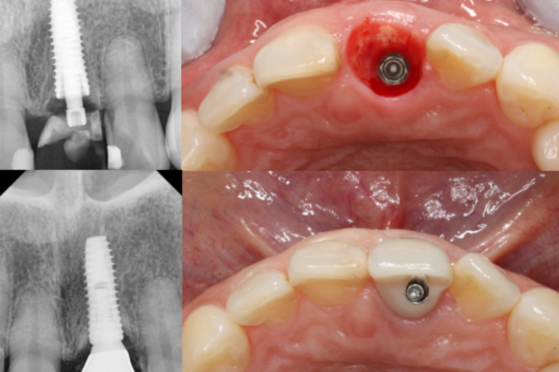 Immediate Dental Implants – Surgical and Prosthetic