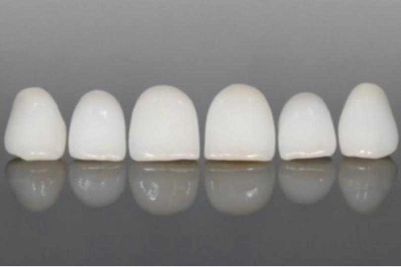 Porcelain Veneers