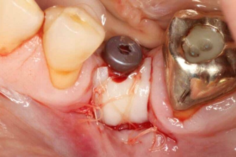 Dental Implant Soft Tissue Plastics Course