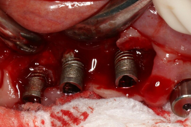 Management of Peri-Implant Disease