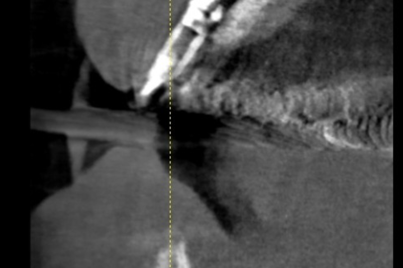 Replacement of missing teeth